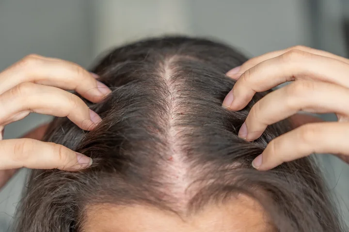 Czy hirudoterapia może zatrzymać Twoje wypadanie włosów?